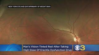 Man's Vision Changes After Taking High Dose Of Erectile Dysfunction Drug, Study Finds