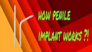 Penile Implant surgery in New Delhi India | How Does Implant Work ?