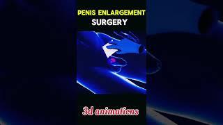 Penis Enlargement surgery #short #viral #penis #surgery #3dmedical