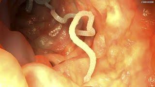 Mom feeds daughter tapeworm to lose weight?